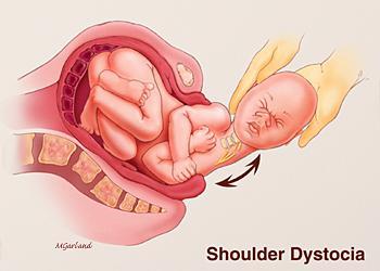 birth-injuries-shoulder-dystocia